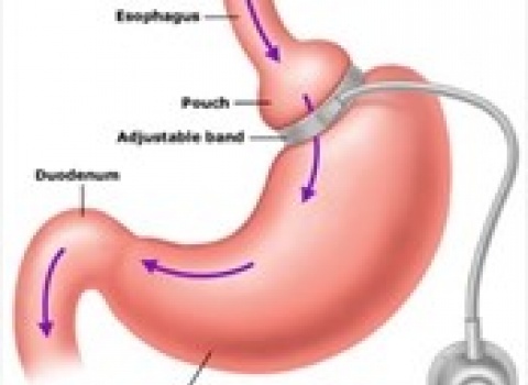 Gastric band