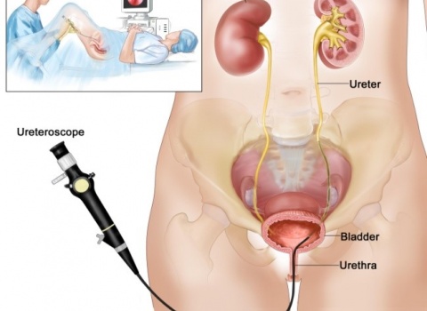 Uretero-renoscopie (URS): kijkonderzoek met behulp van een flexibele camera in de urineleider