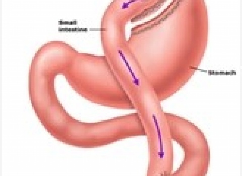Gastric bypass