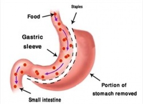 Sleeve gastrectomie